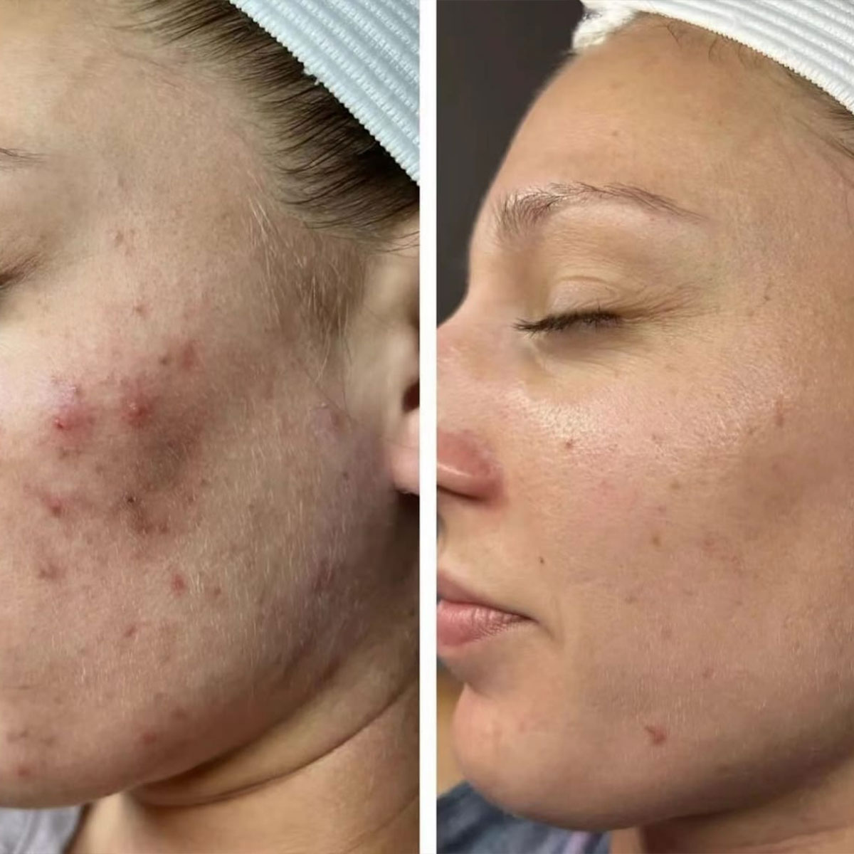Ministry of Beauty - Co 2 Laserbehandlung gegen Akne Narben - Glatte Haut - Selbstvertrauen