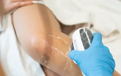 Haarentfernung: 10 Methoden, die Ihre Haut ruinieren – Diodenlaser siegt!