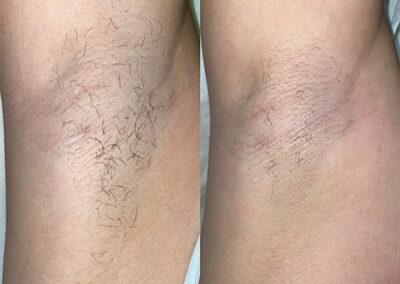 Vorher-Nachher-Bild der Achsel nach einer Diodenlaser-Haarentfernung bei Ministry of Beauty in Essen. Deutlich sichtbare Haarreduktion und glattere Haut.